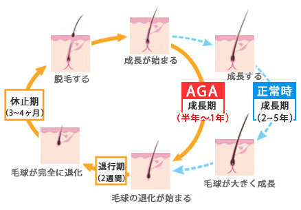 AGAと正常時のヘアサイクル比較