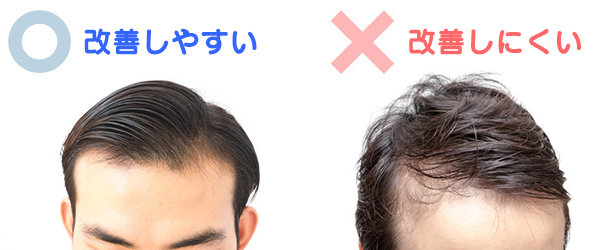 ハゲる原因 これが一番危ない 注意するべき原因を紹介 はげ 禿げ に真剣に悩む人のためのサイト